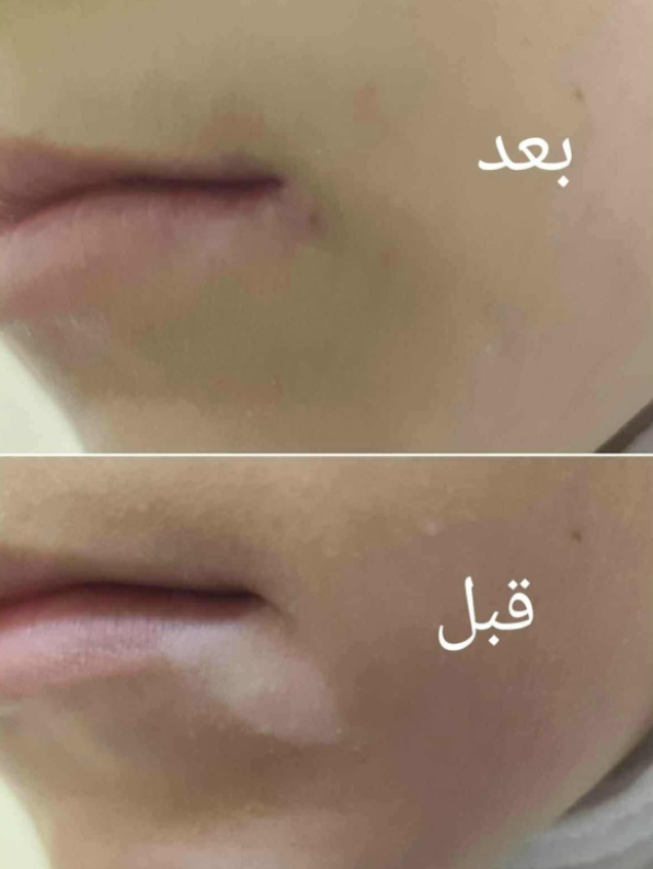 الأردن .. مستشفى الامير هاشم يجري عمليات زراعة خلايا صبغية لمرضى البهاق - صور