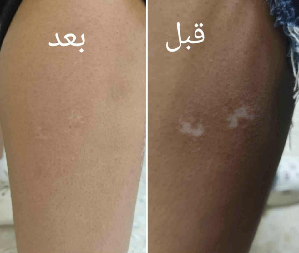 الأردن .. مستشفى الامير هاشم يجري عمليات زراعة خلايا صبغية لمرضى البهاق - صور